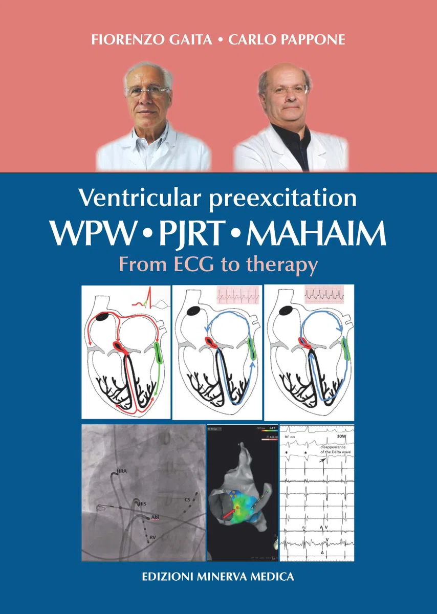 Ventricular preexcitation: WPW, PJRT, MAHAIM. From ECG to therapy